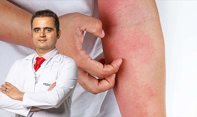 Uyuz hastalığından kurtulmak mümkün mü? Uzman açıkladı
