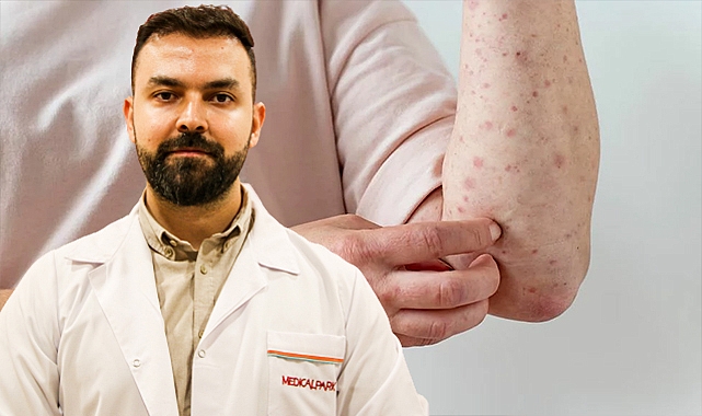 Uyuz vakaları arttı! Uzman uyardı