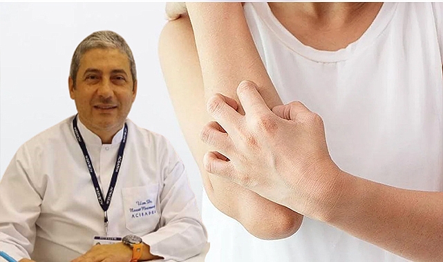 Uzmanından uyuz hastalığı ile ilgili açıklamalar