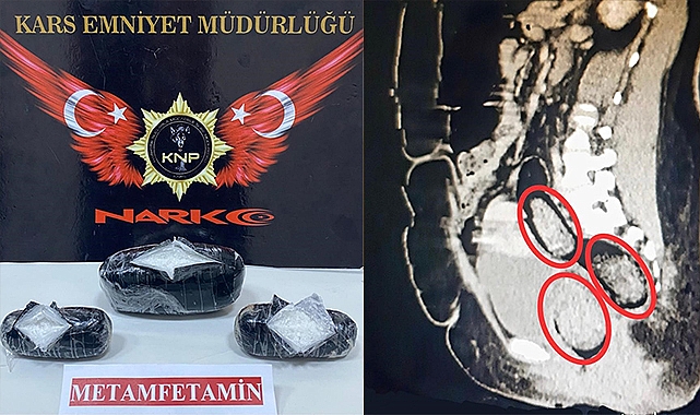 İranlı kadının bağırsaklarından uyuşturucu çıktı