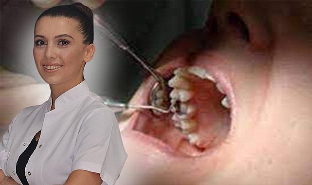 Süt dişleri arasında boşluğa dikkat, dişlerde çapraşıklığa neden oluyor