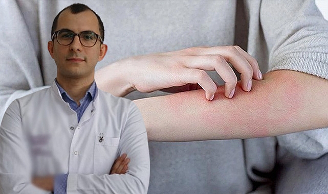 Uzmanı uyardı, uyuz tedavisinde ilaçlar yetersiz kalıyor