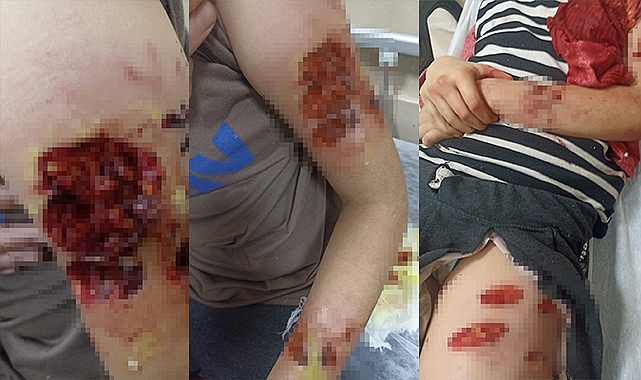 Şanlıurfa’da köpek saldırısında ağır yaralanan kız çocuğu Antep'te tedavı altına alındı