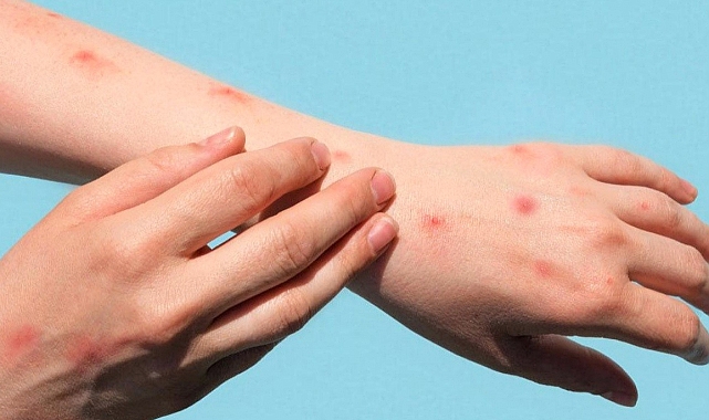 Sağlık Bakanlığı 'maymun çiçeği rehberi' yayımladı