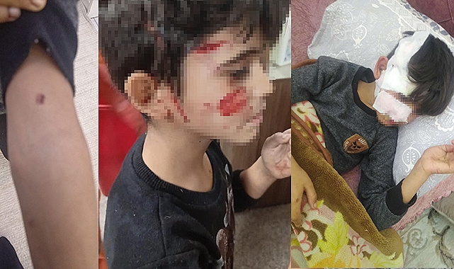 Gaziantep'te 8 yaşındaki çocuğa 5 sokak köpeği saldırdı
